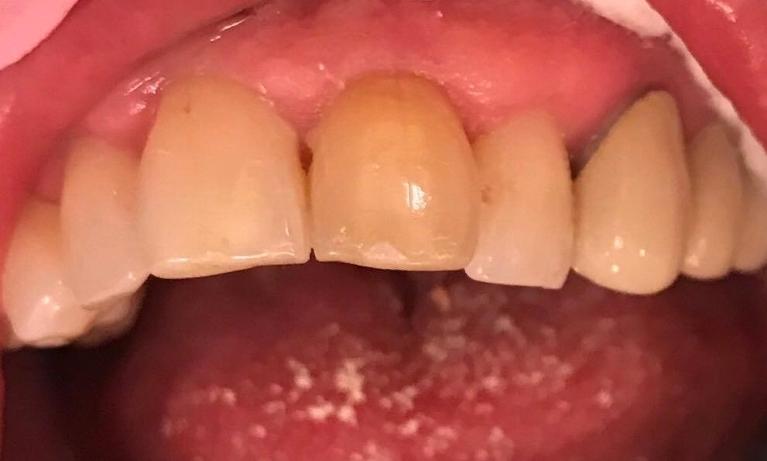 Smile Gallery | Hamilton NJ Dentist | Before & After Images